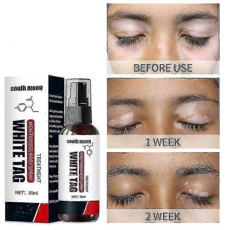 2025 Vitiligo Spray, Vitiligo Treatment For Skin Vitiligo, Vitiligo Care Spray For Reduce White Spots