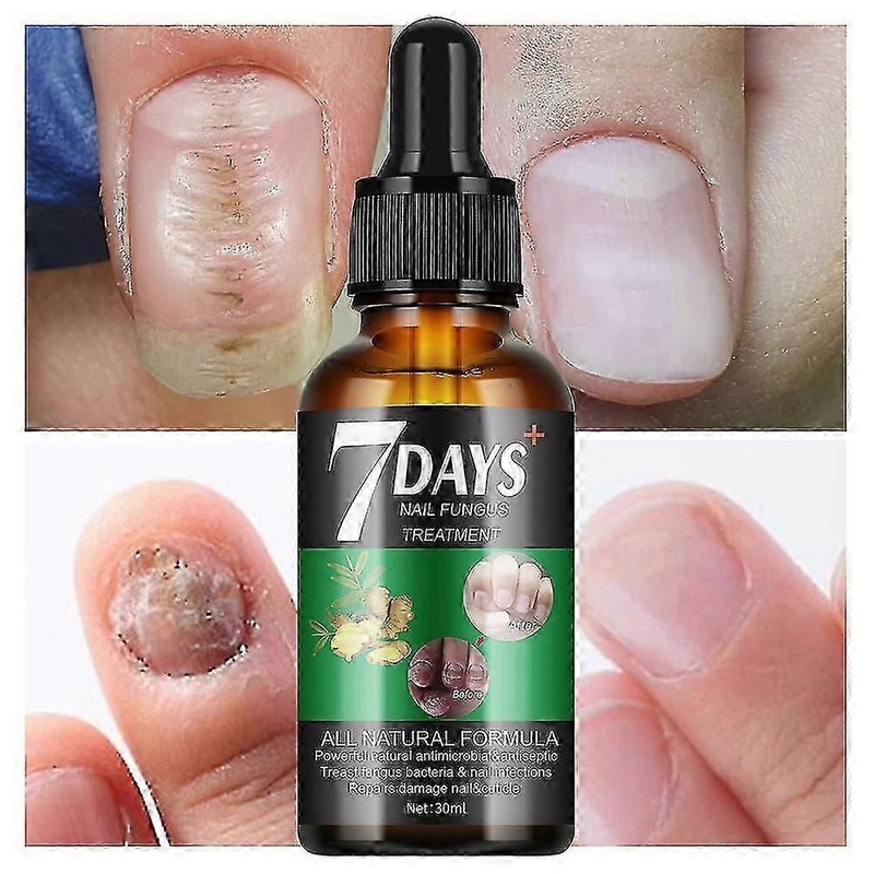 Suitable for Nail Fungus Treatment, Growth & Strengthening Serum, Repair Solution for Healthy Nails